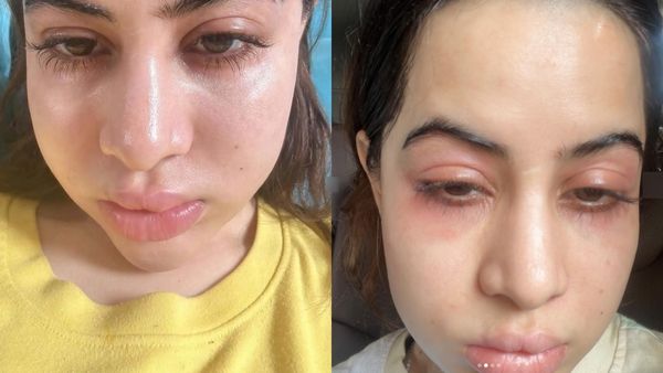 முகம், கண் எல்லாம் வீங்கி போச்சே.. அய்யோ பாவம் என்னாச்சு.. உர்ஃபி ஜாவேத்தை நலம் விசாரிக்கும் பேன்ஸ்!