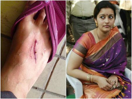 అయ్యో...: గాయపడిన రేణు దేశాయ్(ఫొటో)