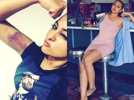 సోనాక్షి గాయం చూస్తే మీరూ చలించి పోతారు...(ఫోటోస్)