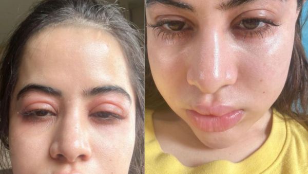 बिगड़ गया उर्फी जावेद का खूबसूरत चेहरा, बोलीं- मैं बुरे दिनों से गुजर रही हूं मुझे सिंपैथी दें...