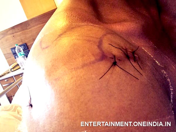 Kushal's Shoulder After Surgery