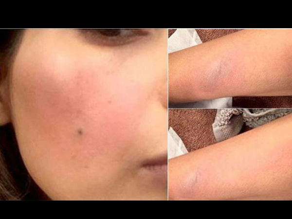 Alia Suffers Multiple Burns On Her Face & Hands