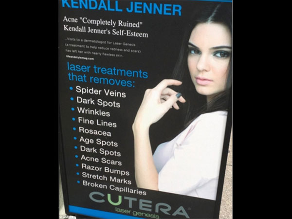 Kendall Jenner Suing Acne Laser Company Cutera For Using Her Picture Without Consent! 