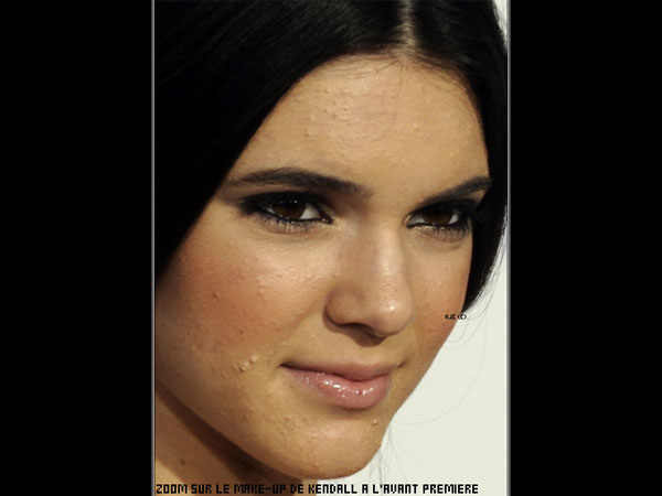 Kendall Jenner Suing Acne Laser Company Cutera For Using Her Picture Without Consent! 
