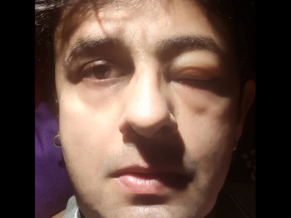 Sonu Shared A Picture Of His Swollen Eye
