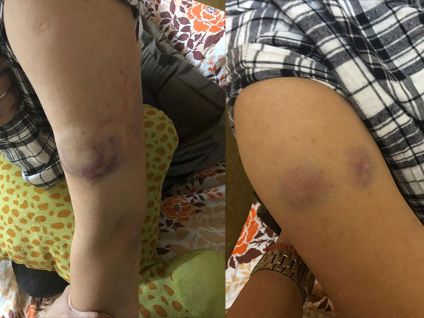 Subuhi Shares Pictures Of Her Injuries Subuhi Shares Pictures Of Her Injuries