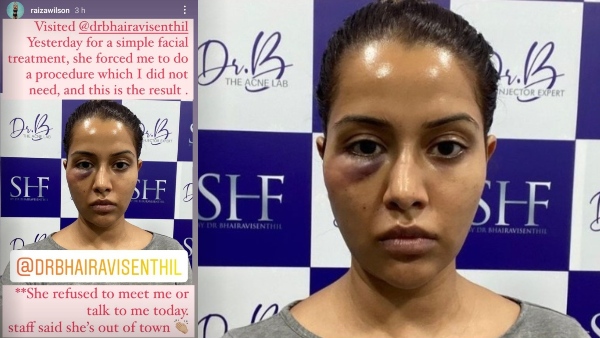 Raiza Wilsons Skin Treatment Goes Horribly Wrong; Actress Lashes Out Against Dermatologist Raiza Wilsons Skin Treatment Goes Horribly Wrong; Actress Lashes Out Against Dermatologist