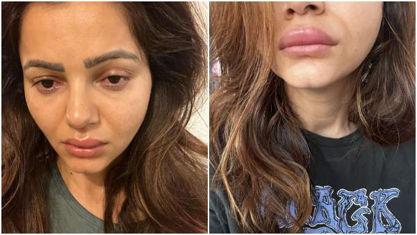 Rubina Dilaik Posts Pictures Of Her Swollen Lips