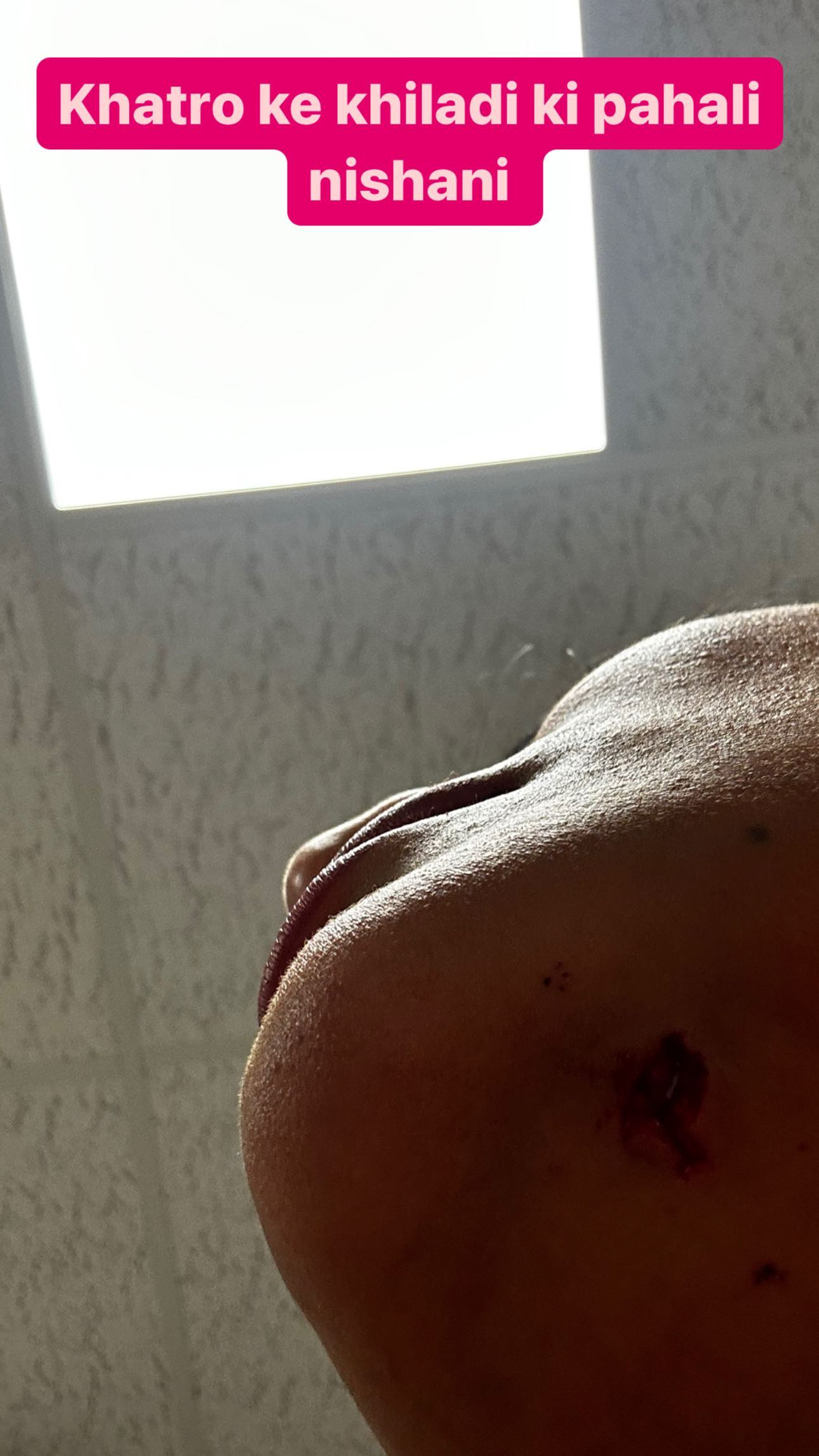 Archana Gautam Injured Archana Gautam Injured