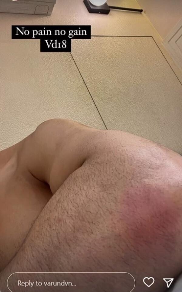 Varun Dhawan Gets Injured On The Sets Of VD18