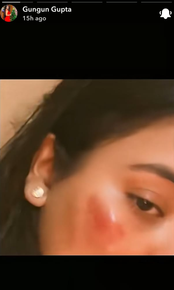 Gungun Gupta Injures Her Face In Accident