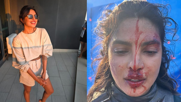 Priyanka Chopra s Injured Face Pics Fact Check