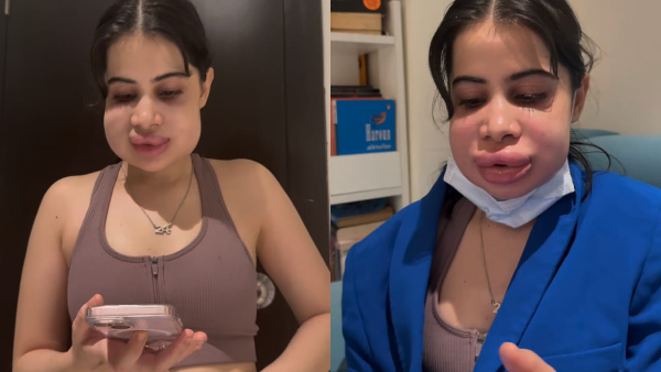 Uorfi Javed New Video Of Her Swollen Face Uorfi Javed New Video Of Her Swollen Face