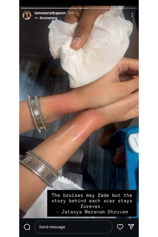 Seerat Kapoor Shares Behind-the-Scenes Injury Ahead