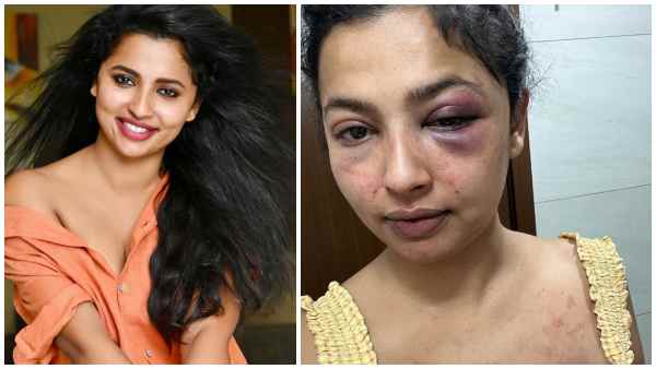 Tamil actress Anicka Vikraman was brutally beaten by her ex boyfriend Anoop Pillai