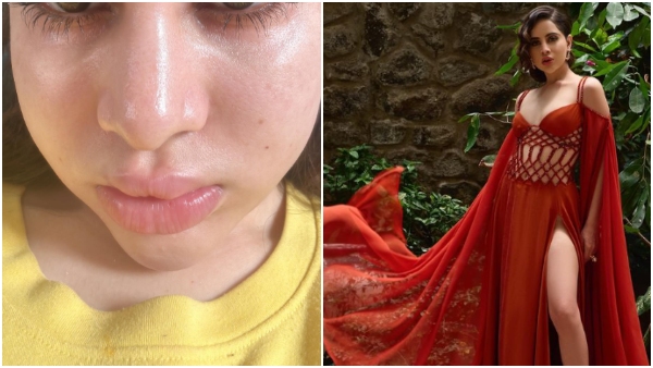 Social media star Urfi Javed health problem swollen face photos went viral