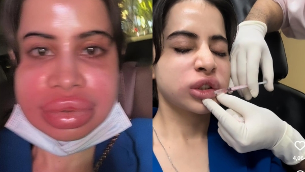 Viral Uorfi Javed s Face Swollen After Ditching Fillers - The Jaw-Dropping Before amp amp After