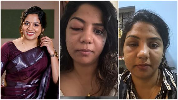 നീര് വന്ന് മുഖം മത്തങ്ങ പോലെയായി, കണ്ണ് തുറക്കാന്‍ പറ്റാതെ അടഞ്ഞു! പെട്ടെന്നുണ്ടായ അസുഖത്തെ പറ്റി വീണ