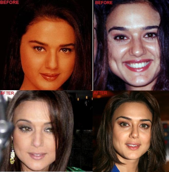 Bollywood Beauties and their Surgeries