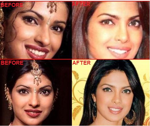 Bollywood Beauties and their Surgeries