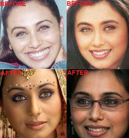Bollywood Beauties and their Surgeries