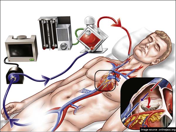 எக்மோ சிகிச்சை 