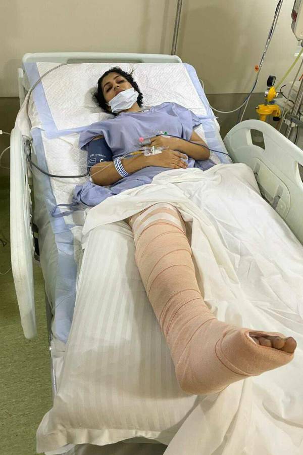 காலில் முறிவு