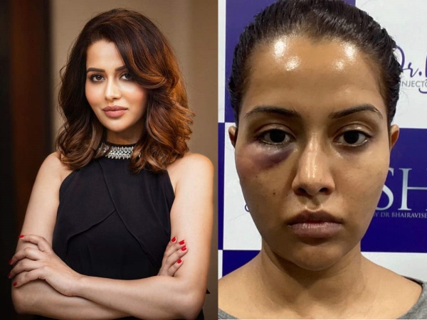 ரைசா முகம் வீங்கிச்சே