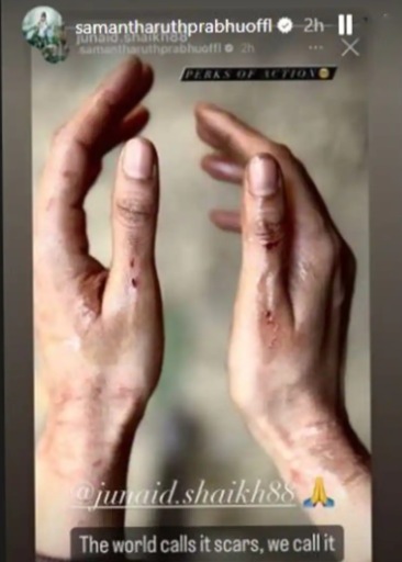  ரத்தக்காயத்துடன் சமந்தா 