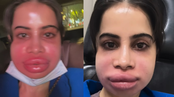 Urfi Javed done lip filler removal and her face turned red and swollen shocks fans