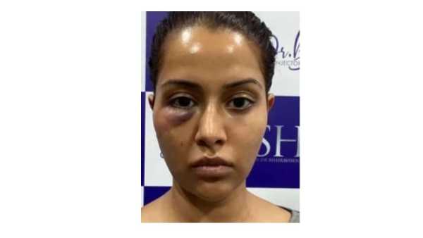  నా కంటి కింద గాయం ఏర్పడి