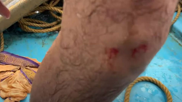 కాలికి గాయం.. కాపాడిన నాని