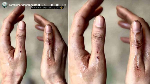 చేతులకు గాయాలు