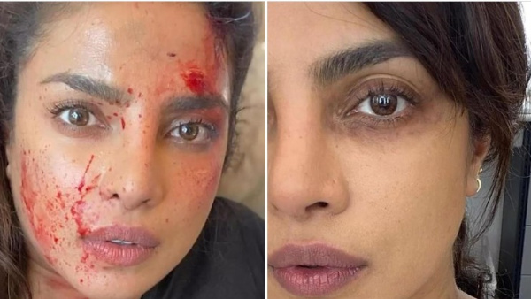 Is Star Heroine Priyanka Chopra attacked Here is the reason behind the injuries