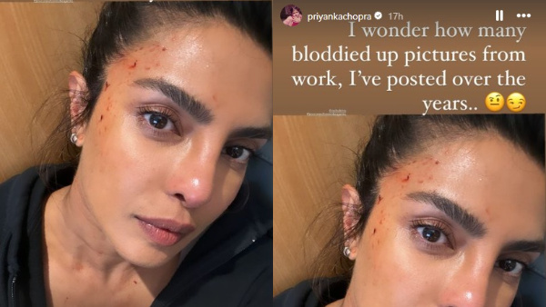 Is Star Heroine Priyanka Chopra attacked Here is the reason behind the injuries